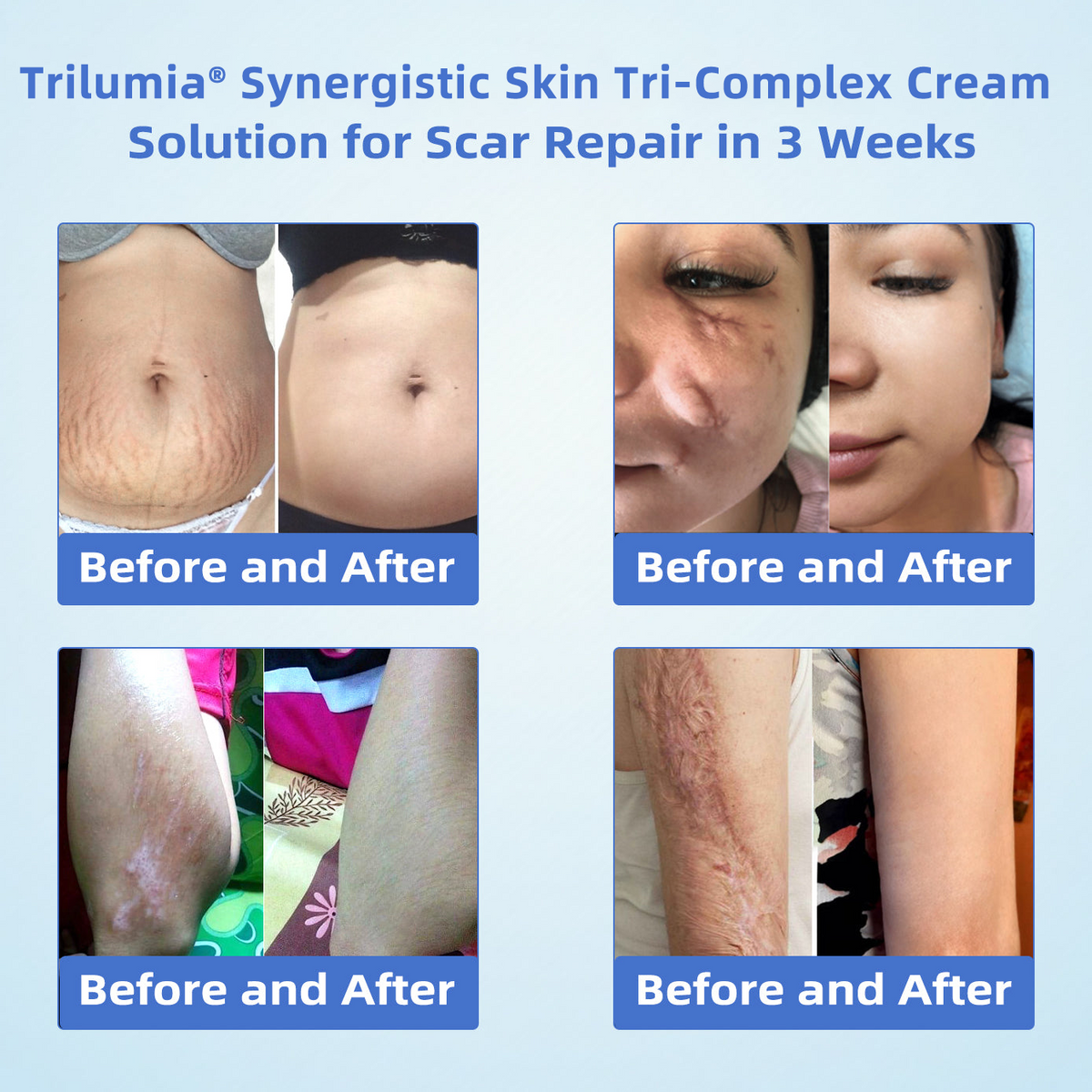 Trilumia® Synergistic Skin Tri-Complex Cream 💎(Copper Peptide+Growth Factors+Methylene Blue)🏆Next-Generation Biotech For Skin Repair